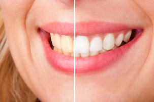חיוך אישה אחרי ולפני הלבנת שיניים