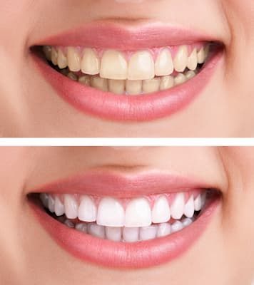 הלבנת-שיניים-לפני-ואחרי-1