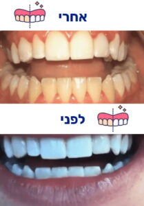 הלבנת שיניים לפני ואחרי תמונה 1