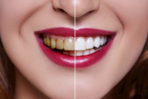 הלבנת-שיניים-לפני-ואחרי-3