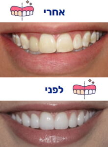 הלבנת שיניים תמונה 4 לפני ואחרי