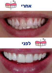 הלבנת שיניים לפני ואחרי תמונה 2