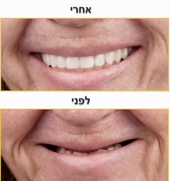 חיוך השתלת שיניים לפני ואחרי