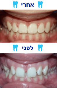 תמונה של לפני ואחרי יישור שיניים