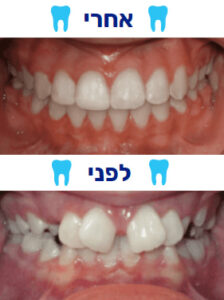 תוצאה טובה ליישור שיניים לפני ואחרי 