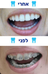 חיוך יישור שיניים לפני ואחרי - 2 תמונות