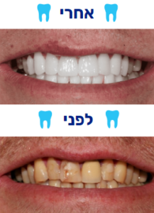 ציפוי שיניים למינייט לפני אחרי תמונה 1