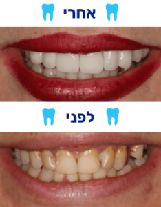 ציפוי שיניים למינייט לפני אחרי תמונה 2