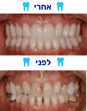 ציפוי שיניים לימנייט לפני ואחרי