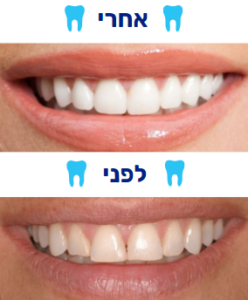 ציפוי שיניים למינייט לפני אחרי הטיפול