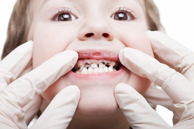 שיניים שחורות אצל ילדים